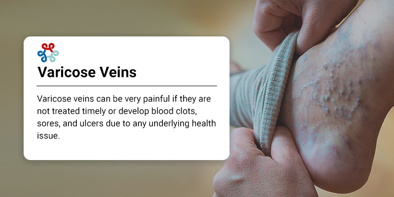 Pain Relief Tips for Varicose Veins