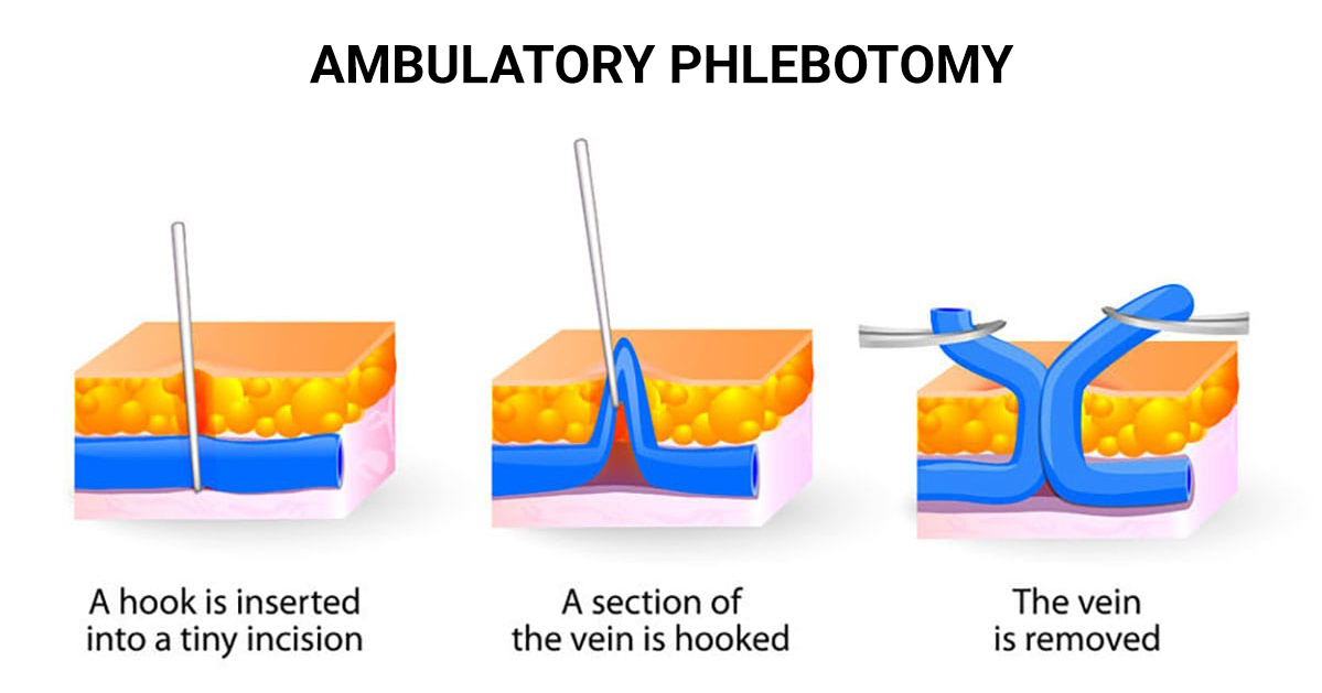 Ambulatory Phlebotomy