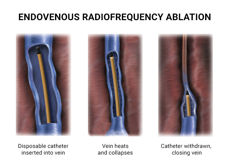 Endovenous Radiofrequency Ablation