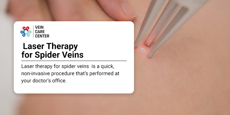 Laser Therapy for Spider Veins