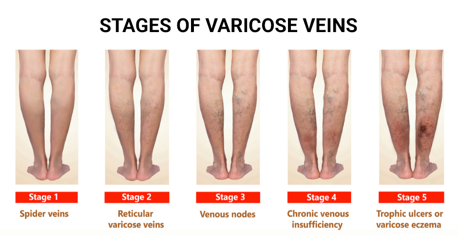 Stages of Varicose Veins