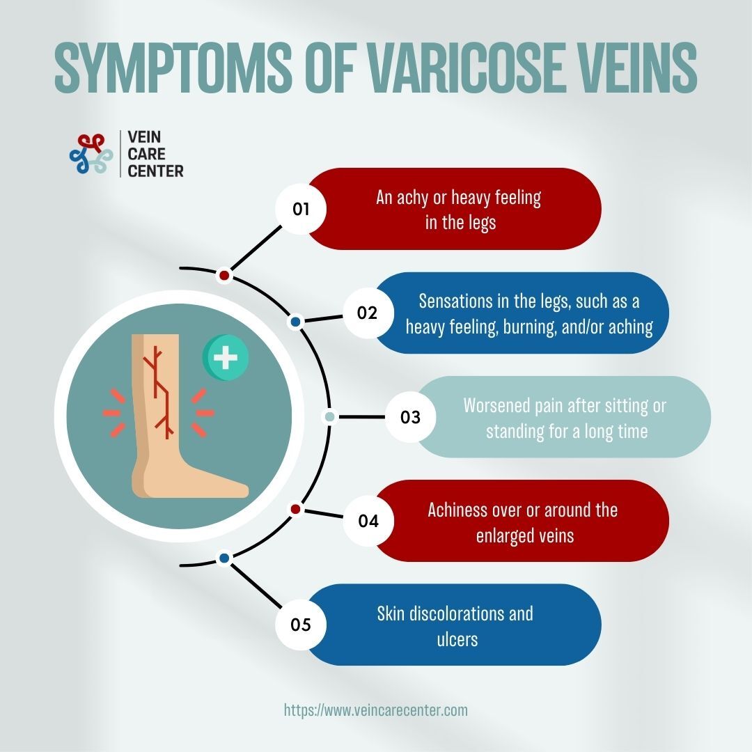 Symptoms of varicose veins